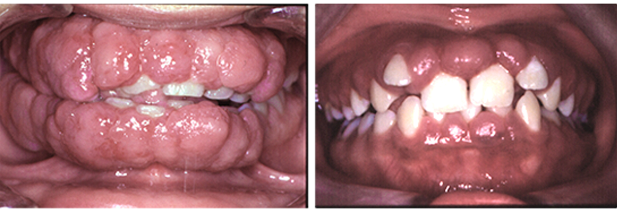 Patients Treated Ciclosporina