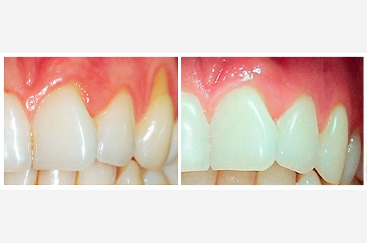 CMP REGENERACION-PERIO-VALE