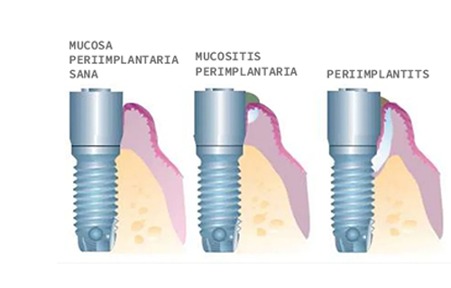 PERIIMPLANTITIS TXT 4